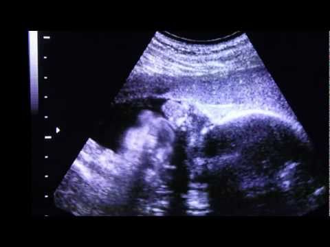 3D 4D Ultrasound Fort Walton Beach video thumbnail