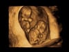 twins 11 weeks 3D ultrasound