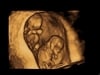 twins ultrasound gallery