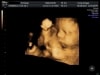 baby 3D ultrasound