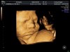 grumpy 3D ultrasound baby image
